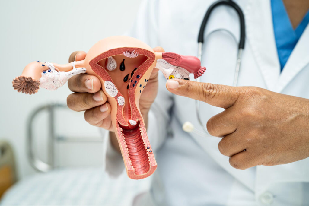 Ovarian Cancer and Fertility